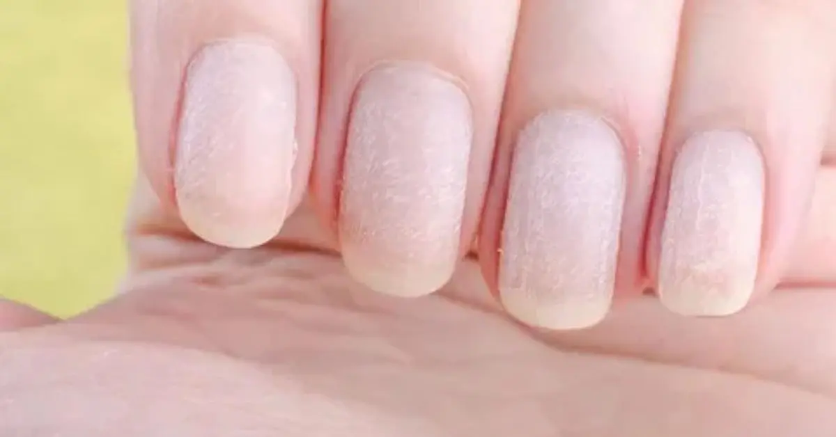 white-spot-nails-after-remover.
