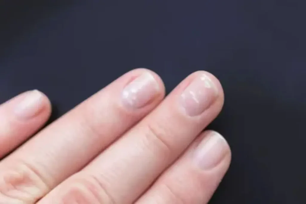 white spots on nails due to health isssues