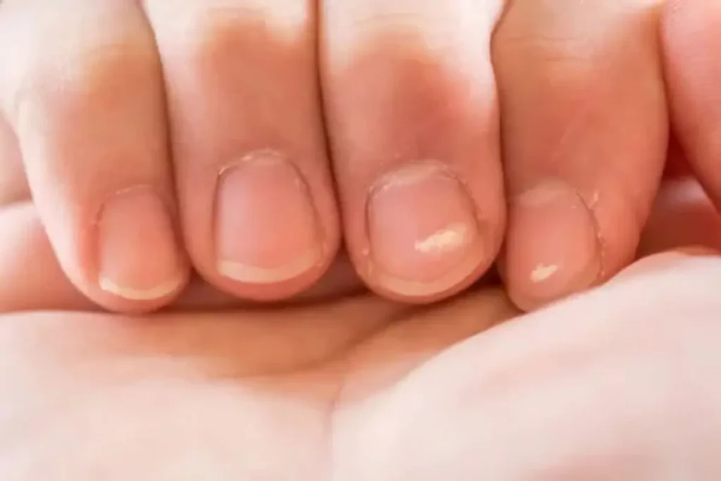 white spots due to heredity