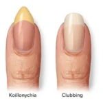 What are some early signs of systemic health issues in nails?
