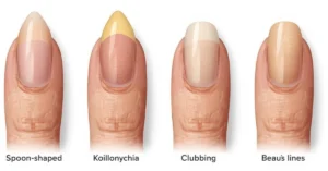 What are some early signs of systemic health issues in nails?